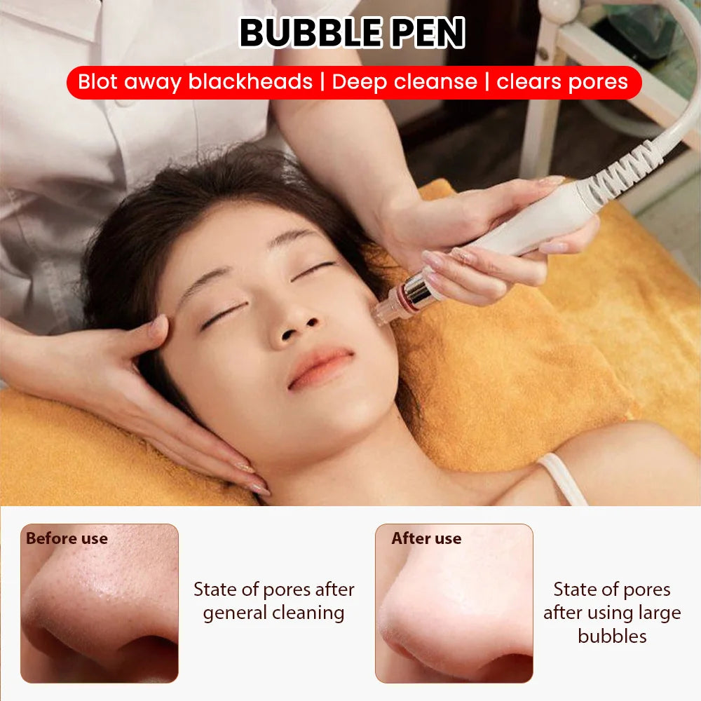 6-in-1 hydro dermabrasion device performing a deep cleansing bubble pen facial treatment for clear, rejuvenated skin.