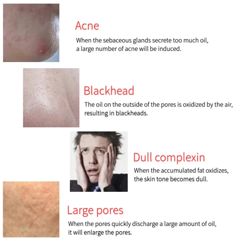 Infographic showing skin issues: acne, blackheads, dull complexion, and large pores with descriptive text labels.