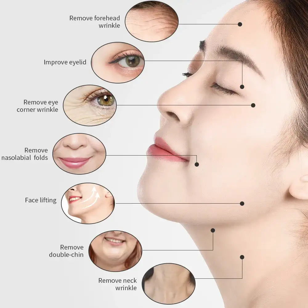 Diagram showing facial areas treated by an RF lifting device to reduce wrinkles, sagging skin, and double chin.