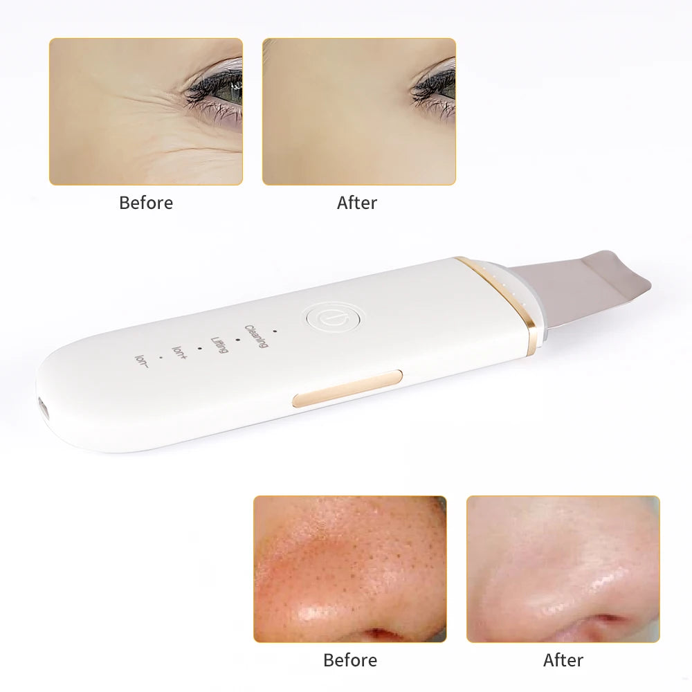 Ultrasonic Facial Skin Scrubber | Professional Deep Cleaning Spatula Scrubs Treatments Tidesmit