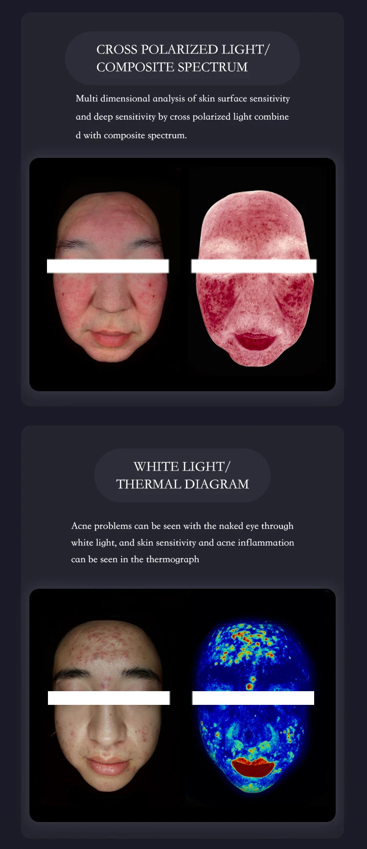 Smart facial skin analysis instrument showing polarized, white light, and thermal imaging of acne and sensitivity.