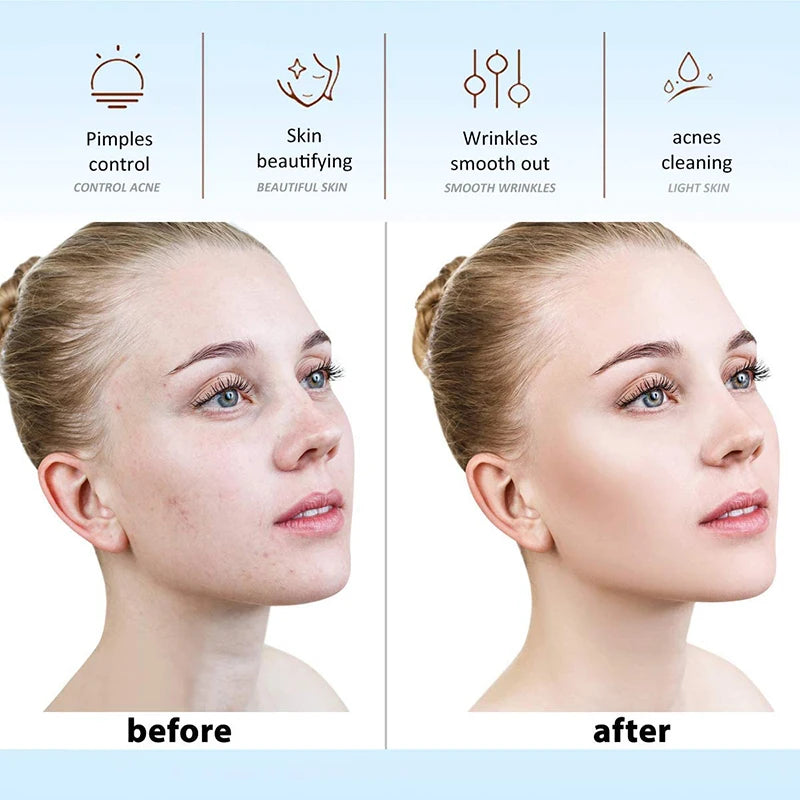 Before and after comparison of a woman's facial skin improvement using a high-frequency skin therapy device.