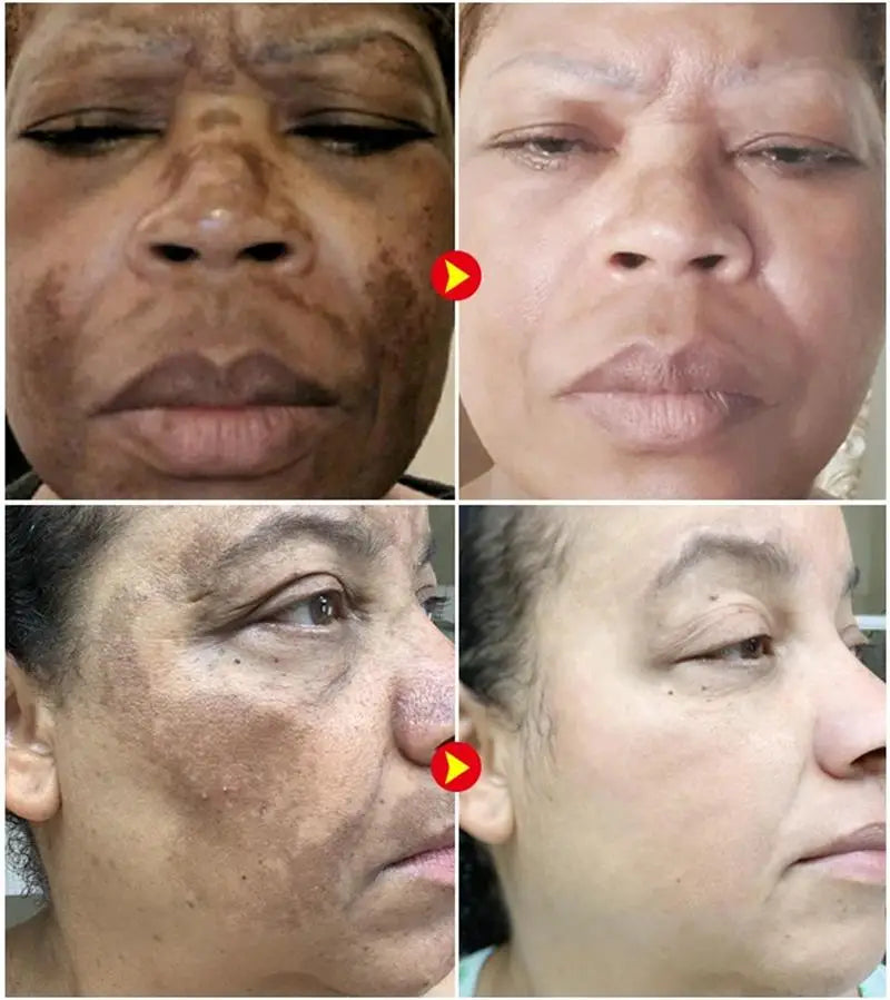 Dark Spot Corrector Cream for Pigmentation & PMU Aftercare | Tidesmit Permanent Makeup Machines Tidesmit