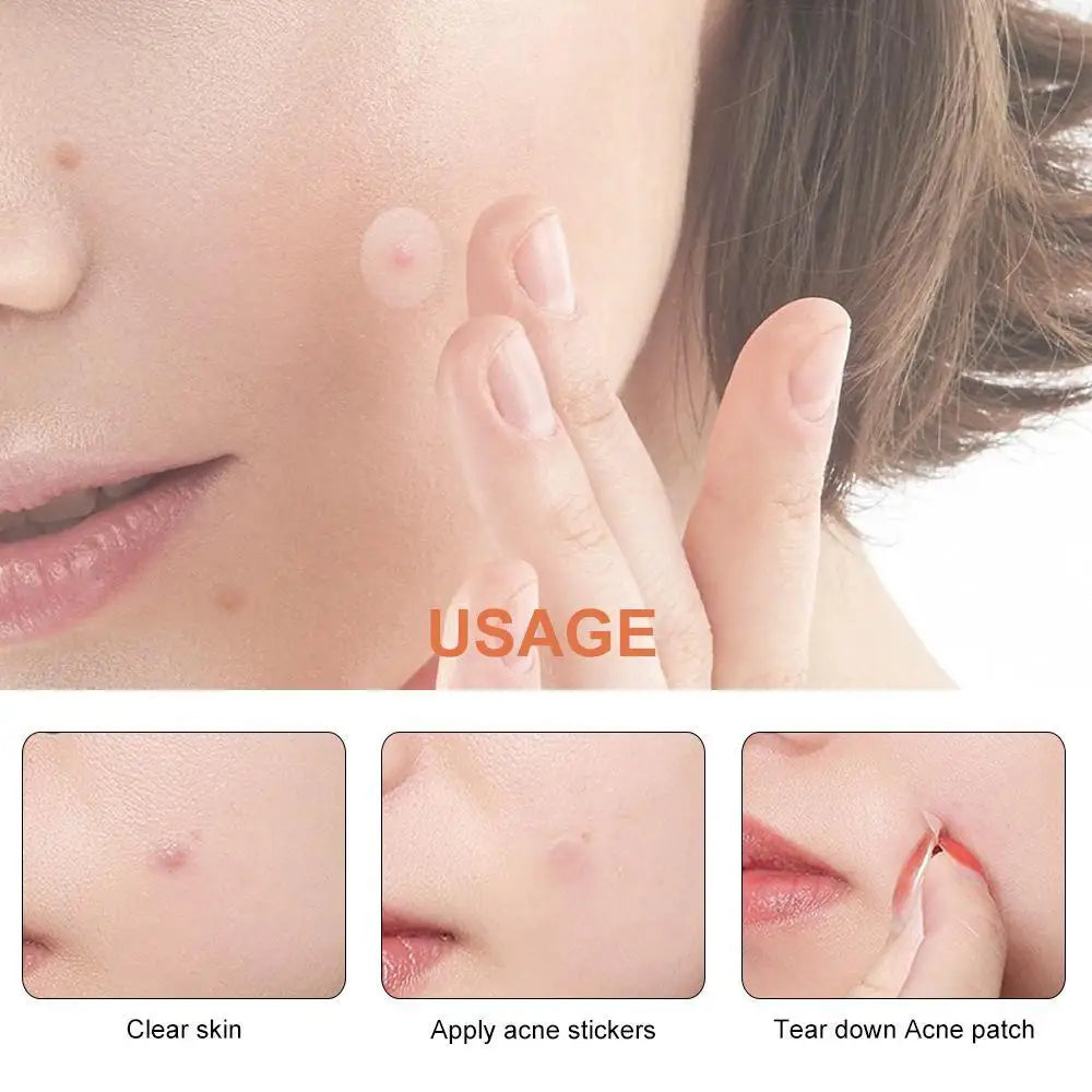 Invisible Pimple Patches for Face with Tea Tree Oil, 72/288 Counts Hydrocolloid Acne Pimple Patches Blemish Dots Patch Stickers