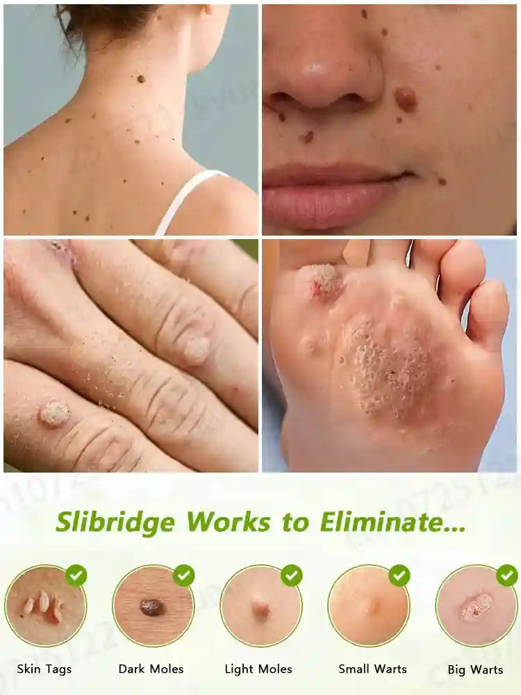 Painless Skin Tag Removal Serum - Fast Acting Home Treatment | Tidesmit Relaxation Treatment Tidesmit