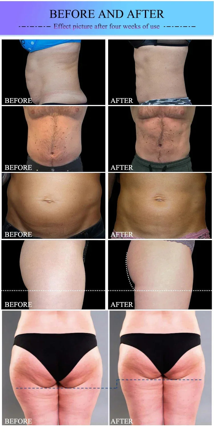 Before and after results of HIEMT EMS RF body sculpting machine for fat loss, muscle toning, and glute lifting.