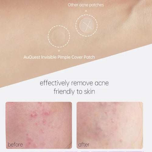 Round white hydrocolloid pimple cover patches sheet on clear backing for spot treatment.