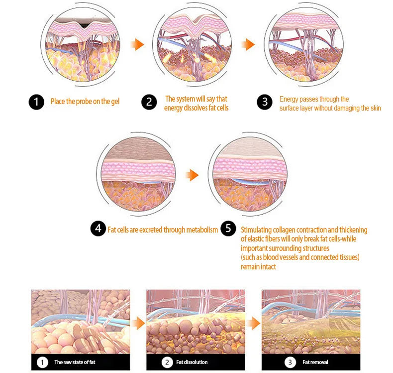 Infographic explaining 576 points Liposonic portable slimming machine process: fat cell dissolution and skin tightening.