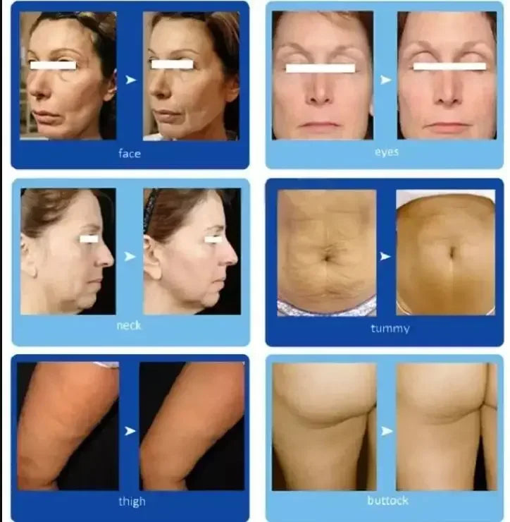 Before and after photos comparing skin appearance on the face, eyes, neck, tummy, thigh, and buttock.