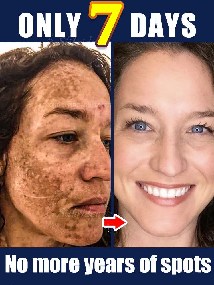 Before and after comparison of a woman's face, showing a significant reduction in dark spots after seven days.