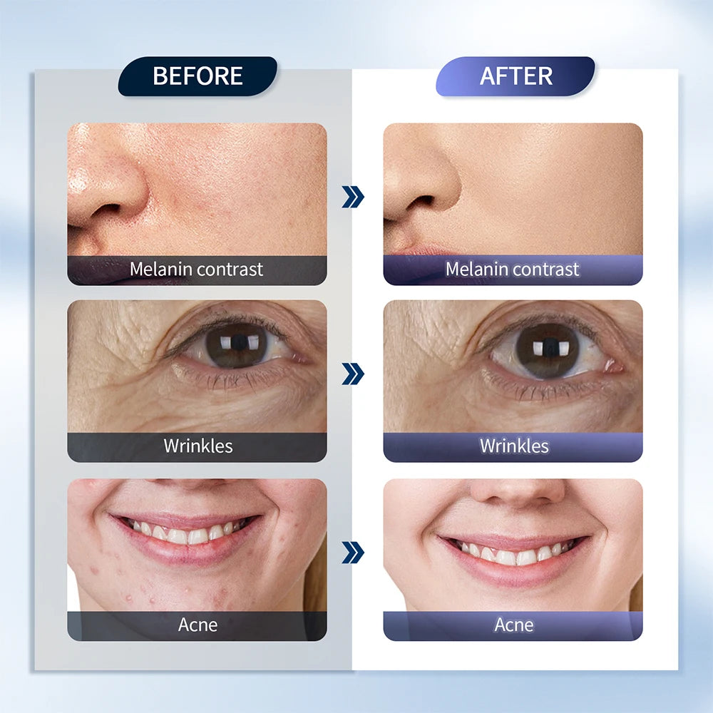 Before and after comparison of skin showing reduced melanin, wrinkles, and acne to demonstrate treatment results.