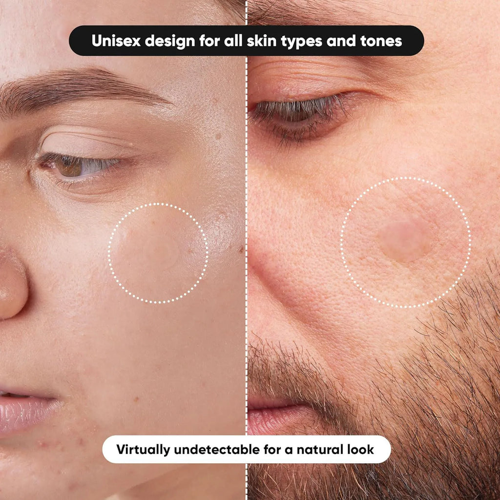 Tidesmit invisible waterproof hydrocolloid acne patch for effective facial blemish treatment and care