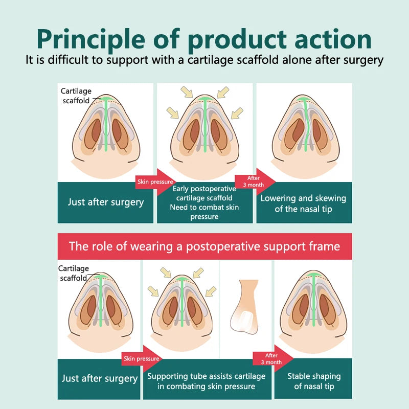 Diagram comparing nasal surgery results with and without a supportive nasal tube frame to prevent tip deformation.