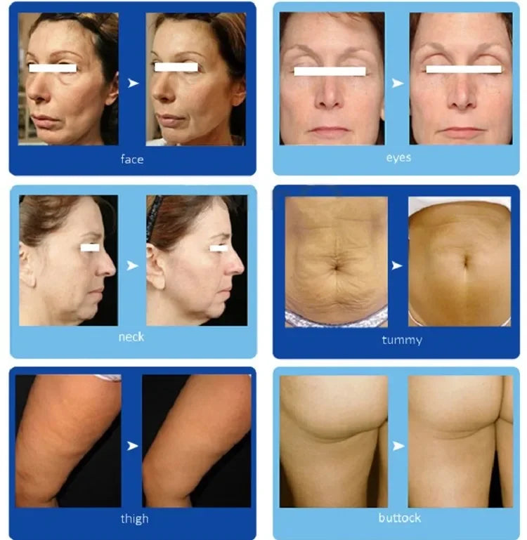 Professional Skin Tightening Machine for Face Lifting and Fat Removal Relaxation Treatment Tidesmit