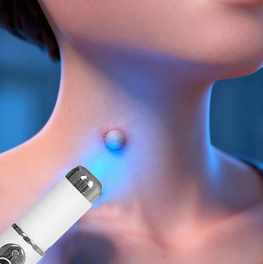 Wart Removal Laser Pen - Painless Home Skin Treatment Tool | Tidesmit Relaxation Treatment 1PCS Tidesmit