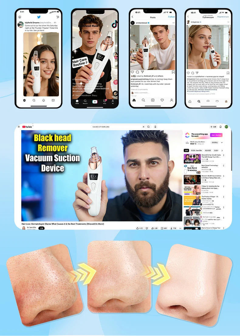 Electric blackhead vacuum remover tool in white and rose gold for deep pore cleansing and acne extraction at home.