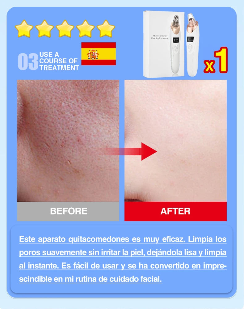 Electric blackhead remover vacuum and pore cleaner with before and after facial skin results for acne and pimples.