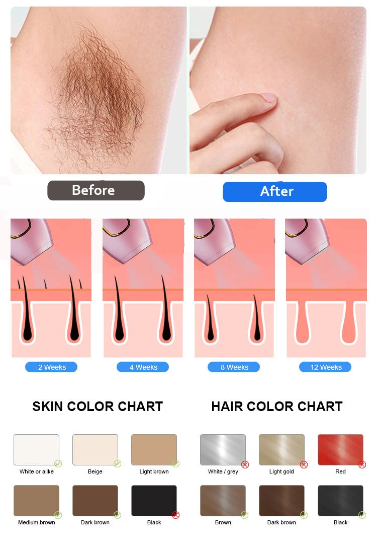 Painless IPL laser hair removal device showing before and after results, 12-week treatment cycle, and skin tone chart.