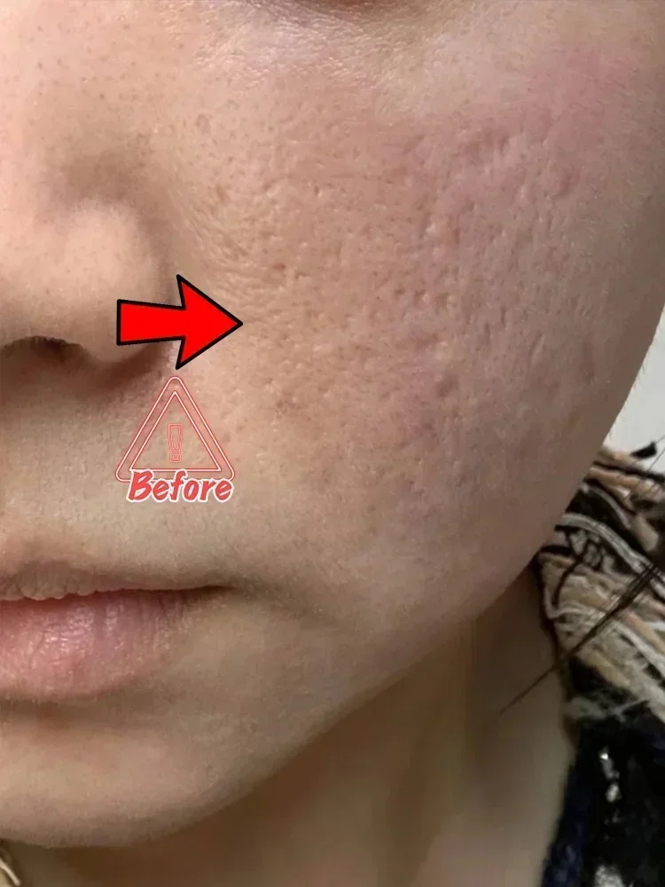 Acne Scar Removal Cream for Pore Repair & Skin Texture - Tidesmit Scrubs Treatments Tidesmit