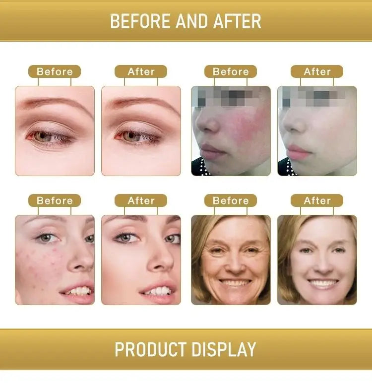 Before and after results of 2-in-1 Ozone Gold Plasma Pen for skin rejuvenation, wrinkle, acne, and melasma removal.