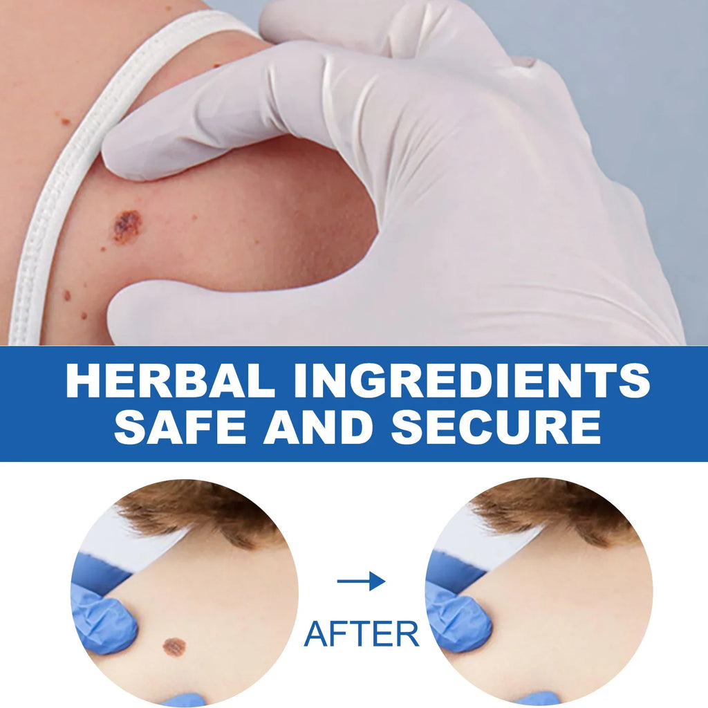 Wart Removal Laser Pen - Painless Home Skin Treatment Tool | Tidesmit Relaxation Treatment Tidesmit