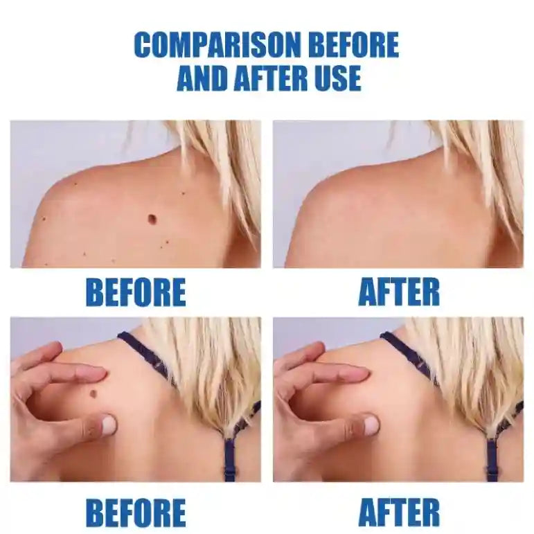 Wart Remover Laser Roller - 7-Day Precision Skin Treatment Tool Massage Roller Tidesmit