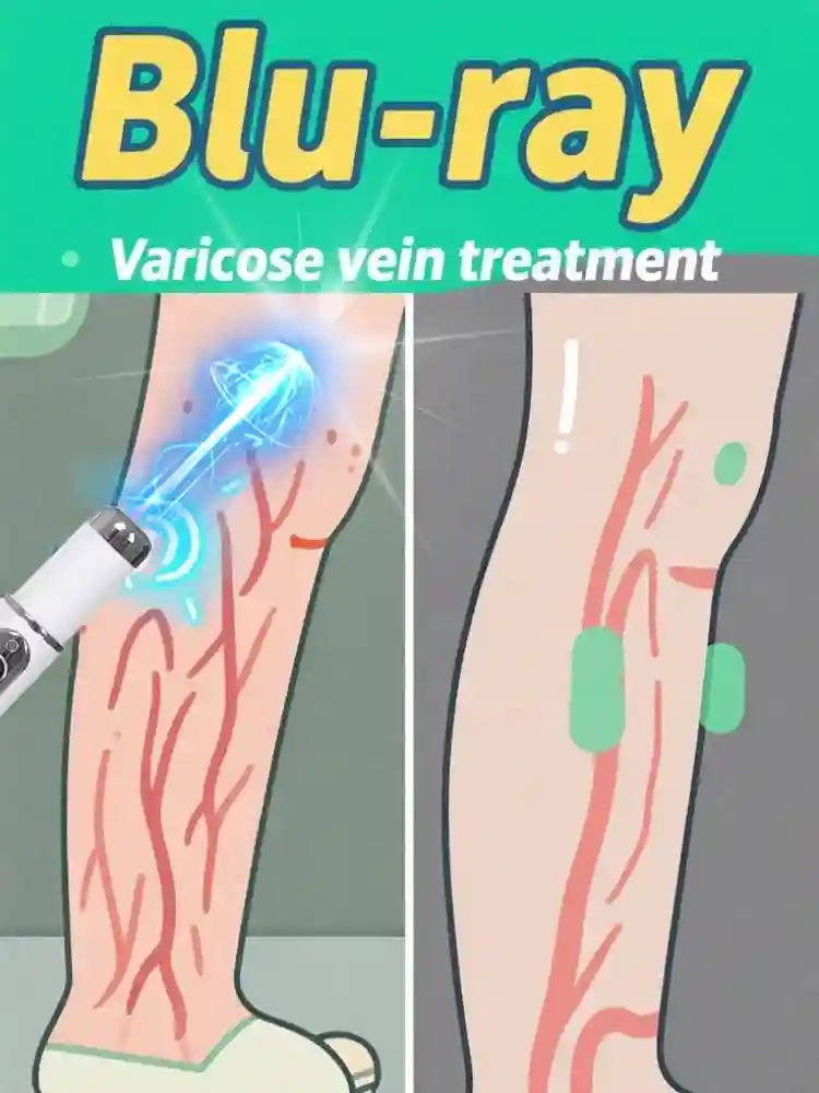 White handheld blue-light device treating leg varicose veins, showing before and after effect on a diagram.