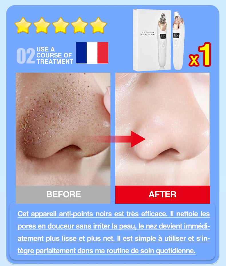 Electric blackhead remover vacuum pore cleaner with before and after nose results for effective facial acne treatment.