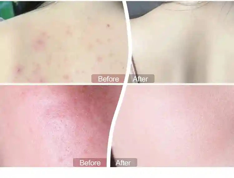 Before and after comparison of skin showing acne reduction from 7 color LED light therapy facial mask treatment.