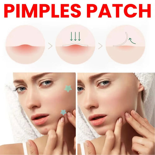 Facial acne pimple patches applied on forehead and cheek, ultra-thin look.