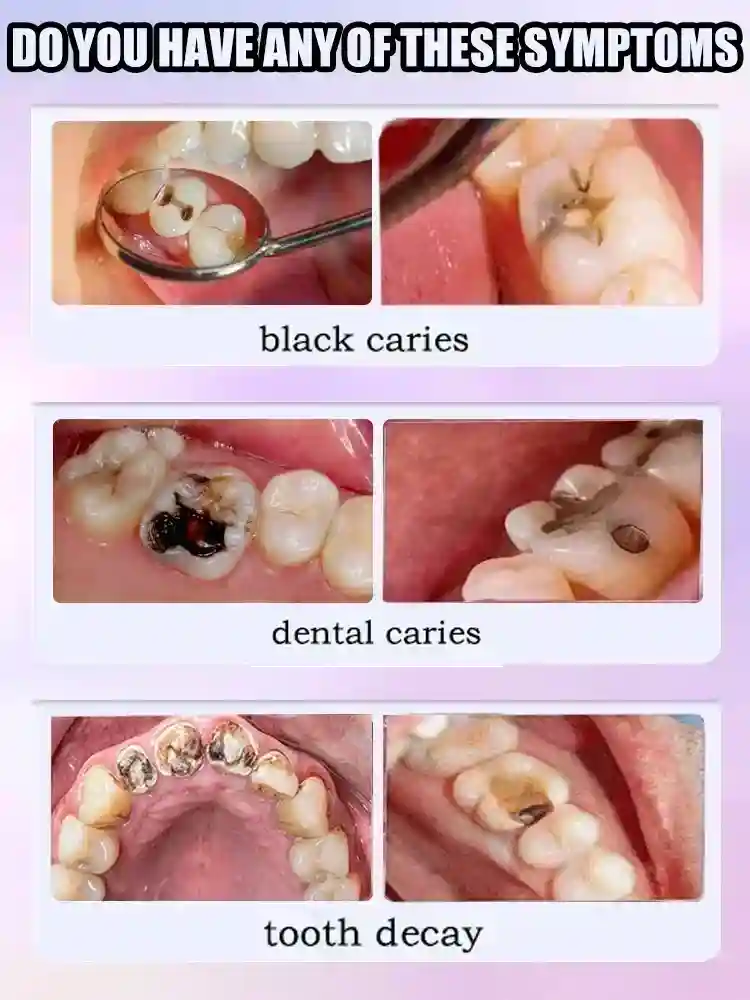 Tidesmit teeth whitening and tooth decay repair cream for cavity protection and enamel color correction