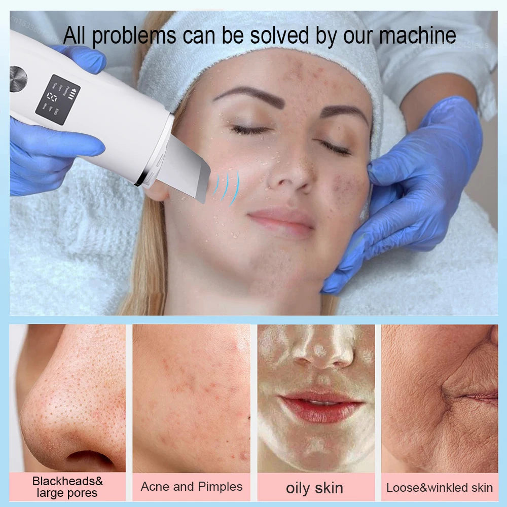 Ultrasonic Face Scrubber - Deep Pore Cleaning & Blackhead Removal Device Scrubs Treatments Tidesmit