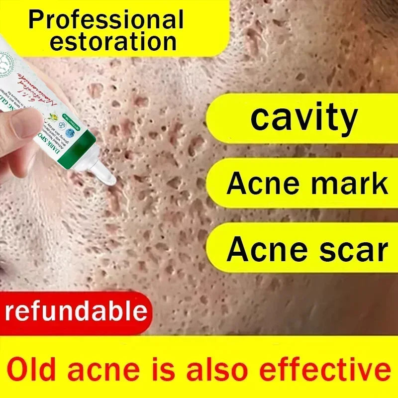 Acne Scar Cream for Face & Pore Fading Treatment | Tidesmit Scrubs Treatments Tidesmit