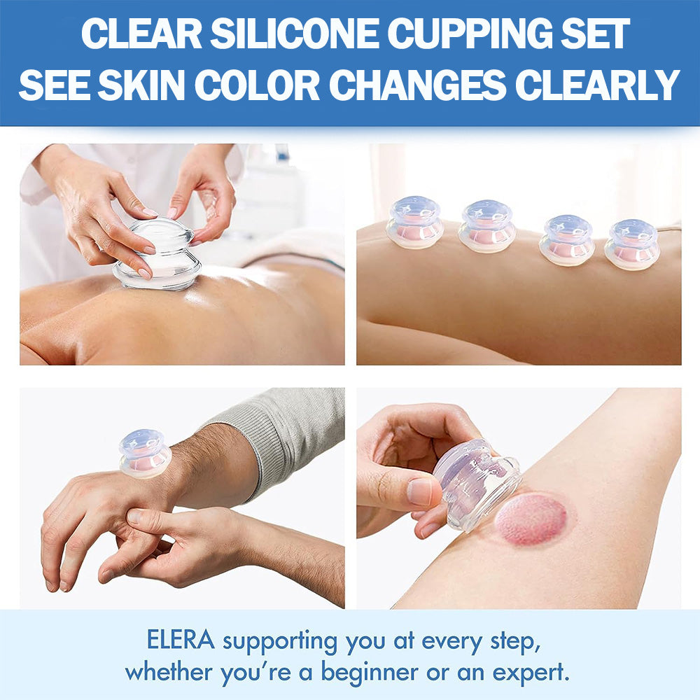 Four clear silicone suction cups used on back, wrist, and arm for therapy, showing skin color changes.