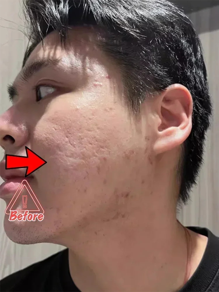 Acne Scar Removal Gel for Men – Professional Pothole Mark Repair Scrubs Treatments Tidesmit