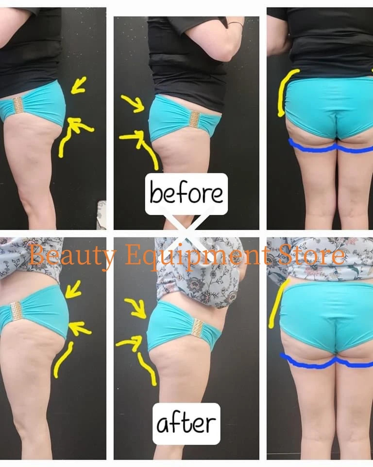 EMS Body Slimming Machine for Muscle Sculpting and Fat Reduction Relaxation Treatment Tidesmit