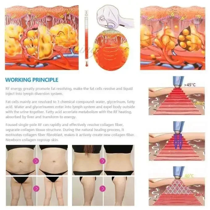 Ultra 360 RF body contouring machine showing fat reduction, skin tightening, and anti-aging results on face and body.