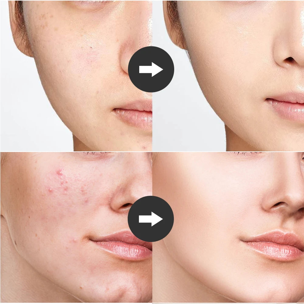 Before and after comparison of facial skin showing reduced acne and clearer complexion after high frequency treatment.