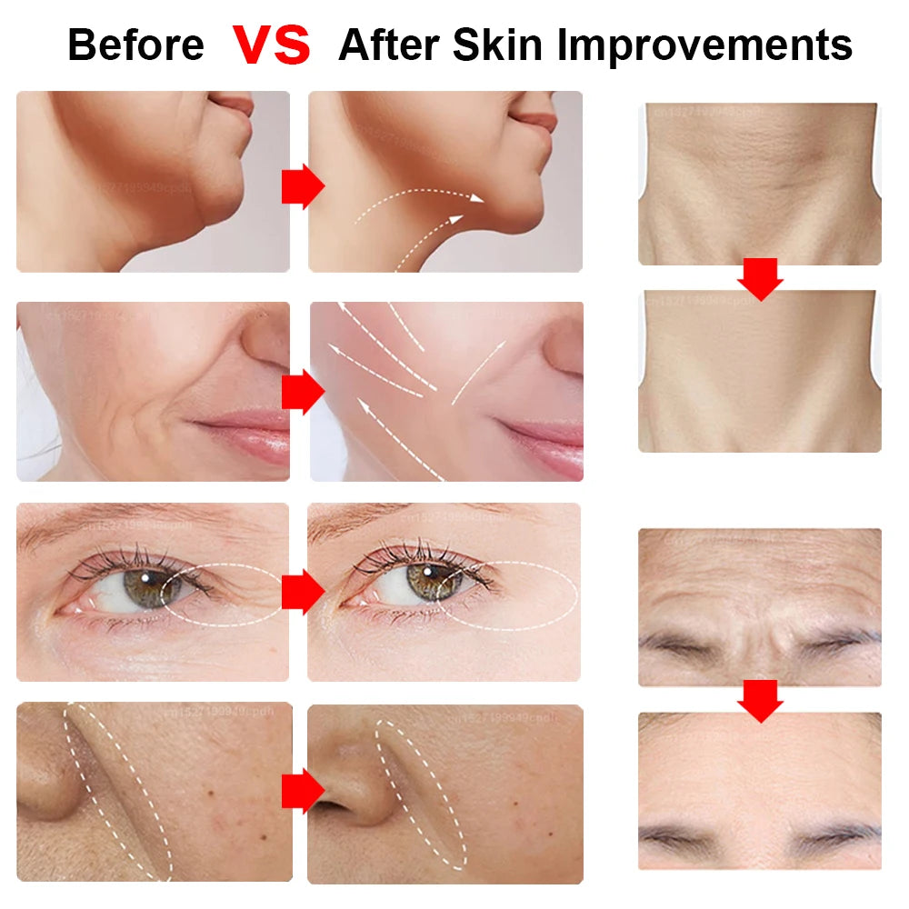 Before and after comparison of mini HIFU, RF, and EMS face lifting machine for wrinkle reduction and skin tightening.
