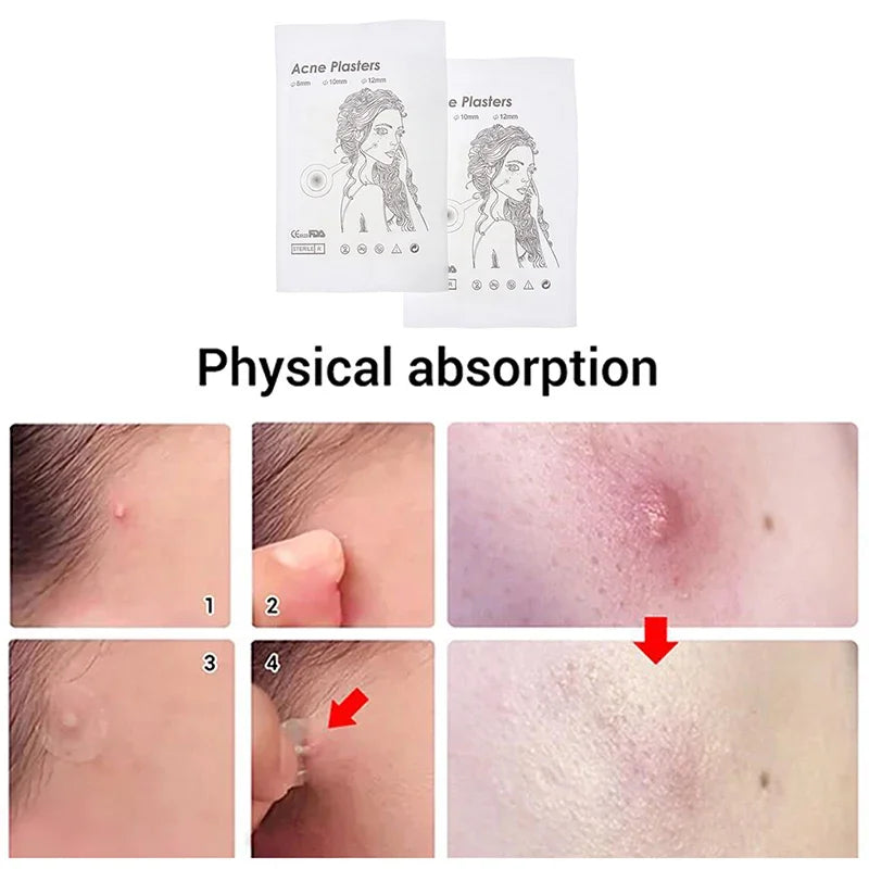 Hot Sale 72Pcs/2Sheets Acne Pimple Patch Clear Gel Invisible Acne Cover Stickers Pimple Remover Beauty Skin Care