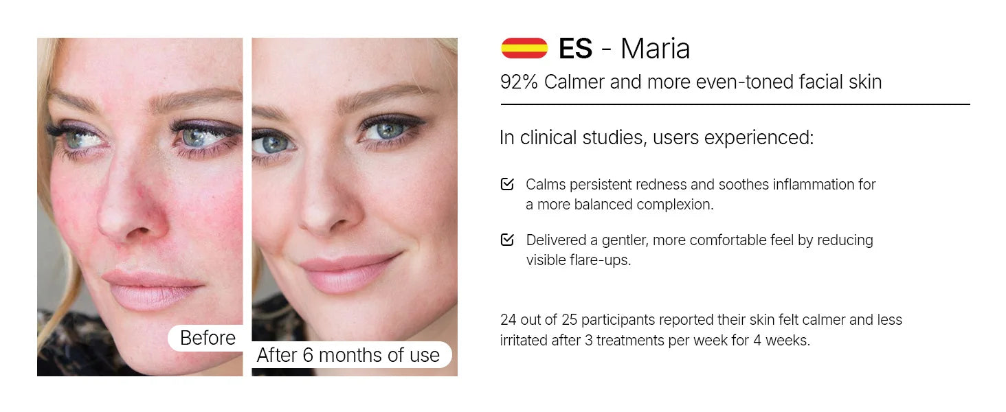 Before and after comparison of a woman's face showing reduced skin redness after 6 months of light therapy treatment.