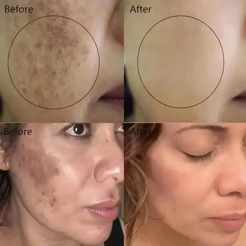 Kojic Acid Freckle Removing Whitening Essence Fade Pigmentation Melasma Dark Spots Corrector Repair Serum Korean Skin Care