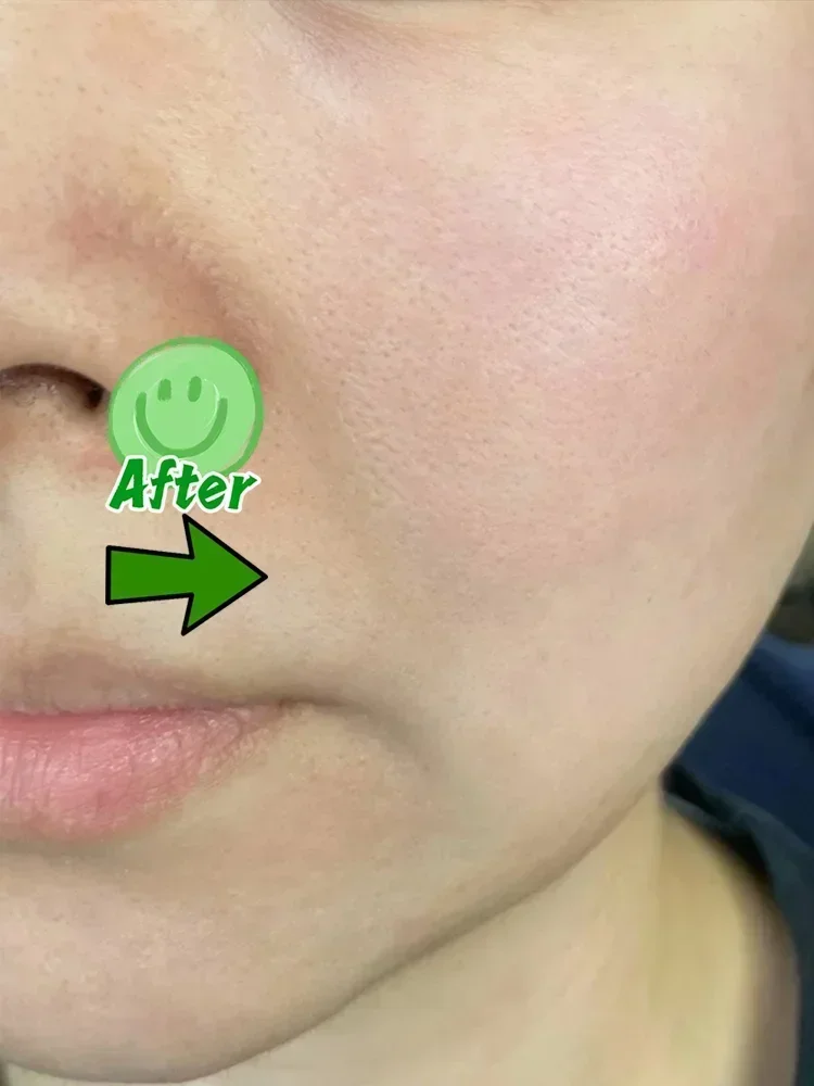 Acne Scar Removal Cream for Pore Repair & Skin Texture - Tidesmit Scrubs Treatments Tidesmit