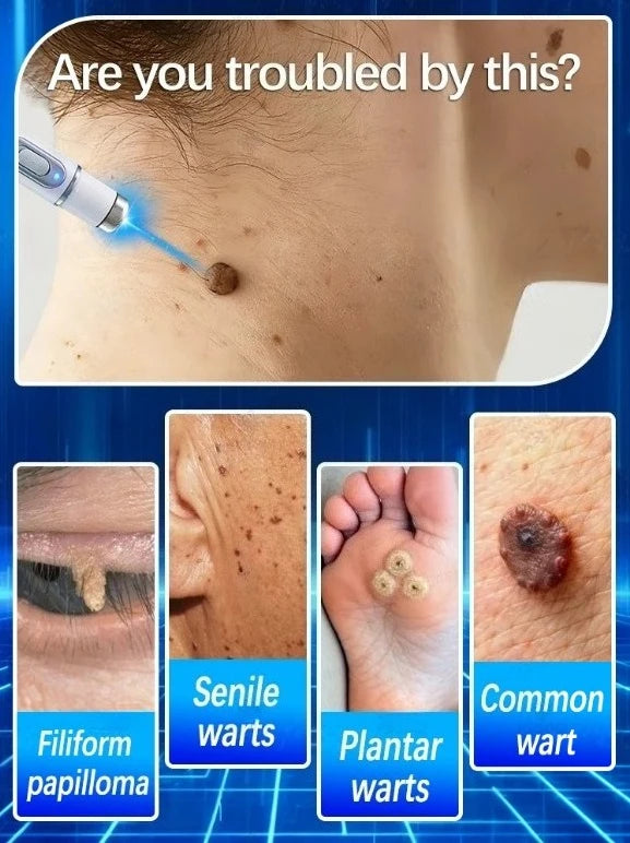 Blue Light Laser Pen for Skin Tag and Wart Removal - Tidesmit EU Relaxation Treatment Tidesmit