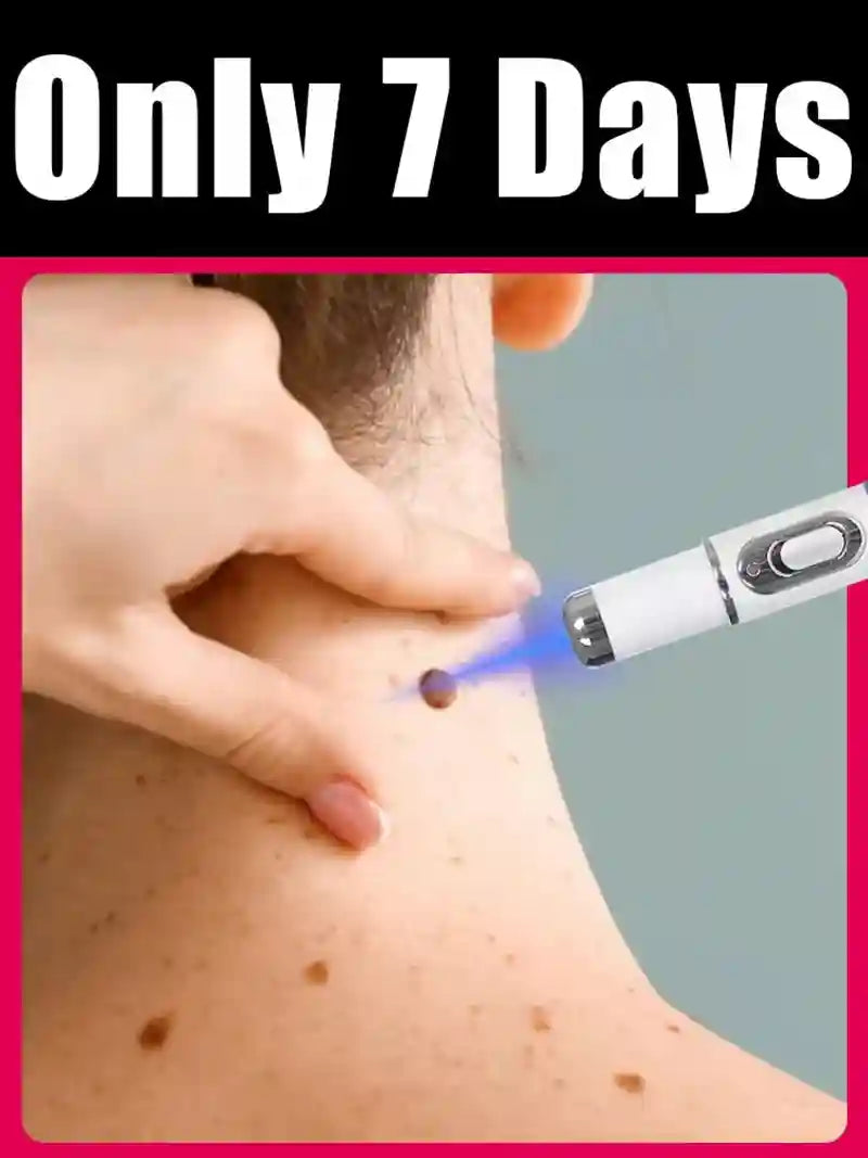 Blue Light Wart Removal Pen | Targeted Skin Care Device | Tidesmit Lip Care Tidesmit