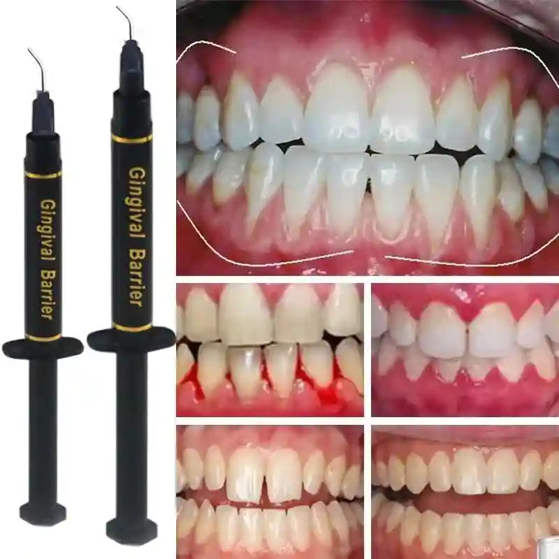 Gingival Barrier Gel for Professional Teeth Whitening - 5PCS Set Lip Care Tidesmit