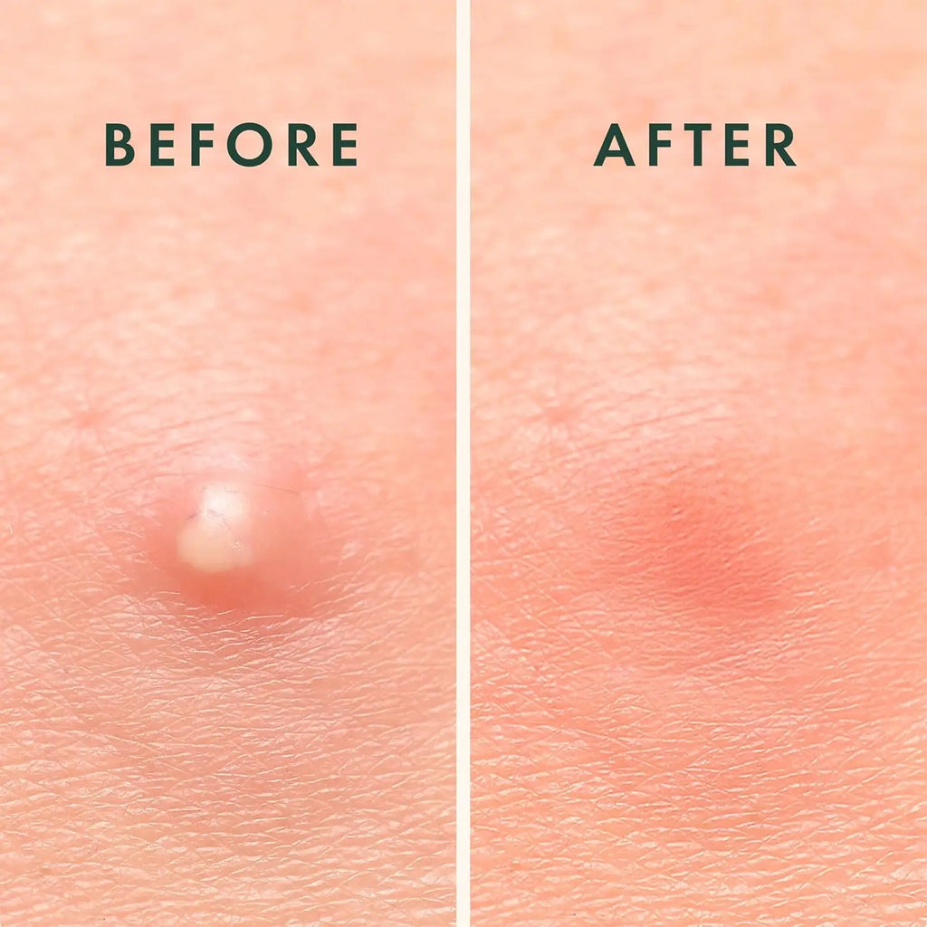 Hydrocolloid Acne Pimple Patches for Face Shrinking Zits Whiteheads Nighttime Spot Pimple Stickers for Face Skin Care Tools