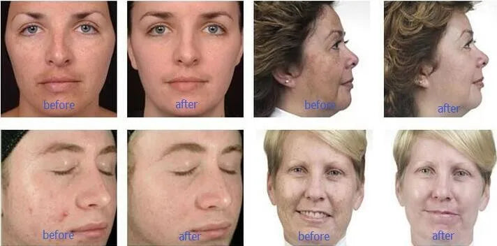 9-in-1 Hydra Facial Machine: Professional Oxygen Jet Skin Care System Massage Chairs Tidesmit
