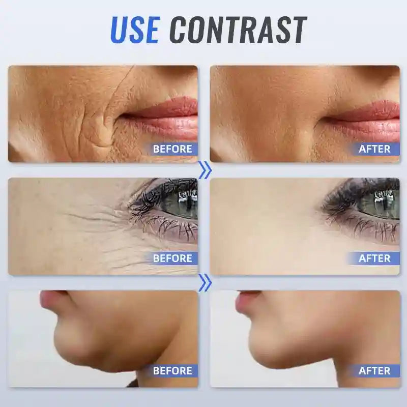 Before and after comparison of skin tightening, wrinkle reduction, and lifting results using Mini HIFU EMS device.