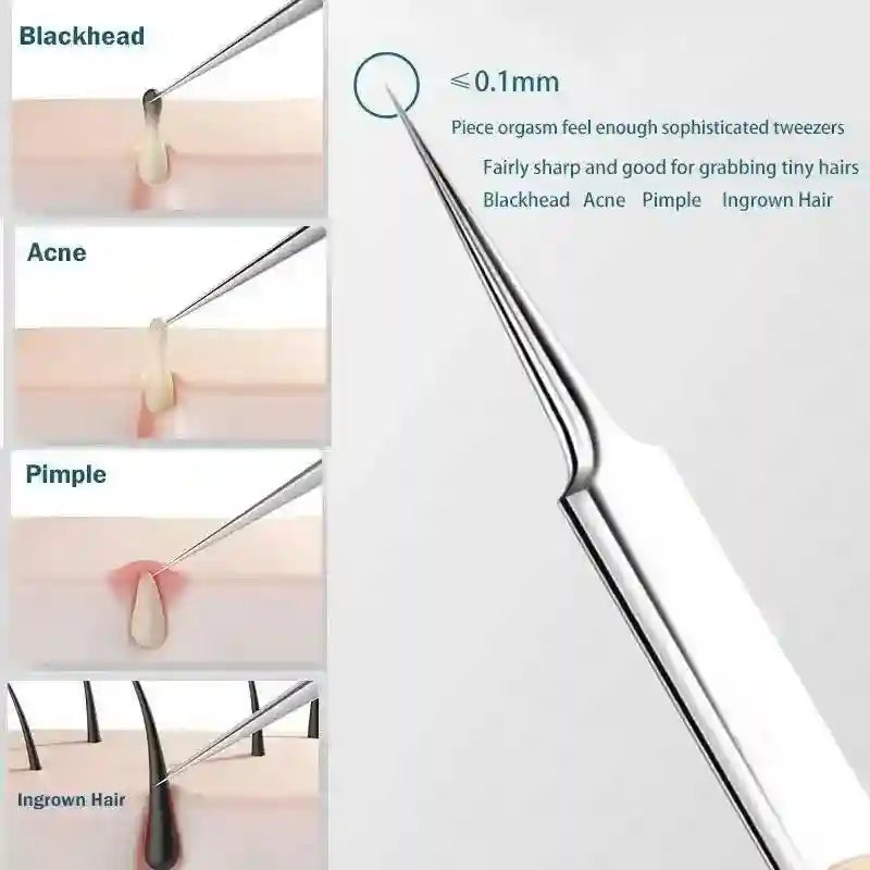 Stainless steel pointed tweezer tool for extracting blackheads, acne, pimples, and ingrown hairs.